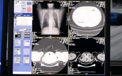 阿里巴巴达摩院出品：“新冠病毒肺炎 AI 辅诊助手”，诊断肺炎20 秒出结果！