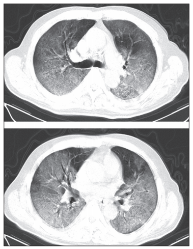 新冠肺炎：CT 影像临床诊断结果是新冠肺炎病例判断的一个重要标准！