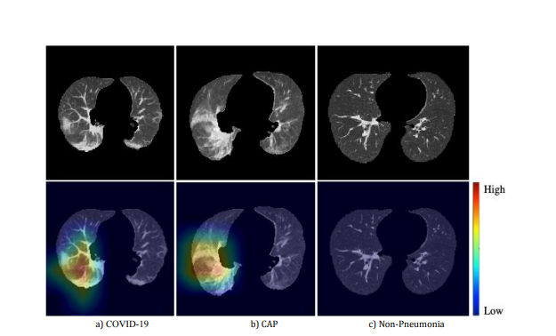 科亚医疗区分新冠肺炎与一般肺炎的“CT+AI”检测研究成果被收录！