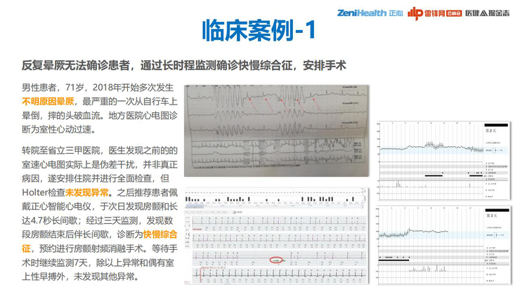 3.3亿患者、千亿级市场，巨头为何做不好一款心电检测仪？