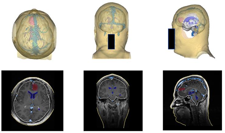 协和与腾讯联合发布国产手术导航系统：可一键生成定制化3D“透明脑”，成本降低90%