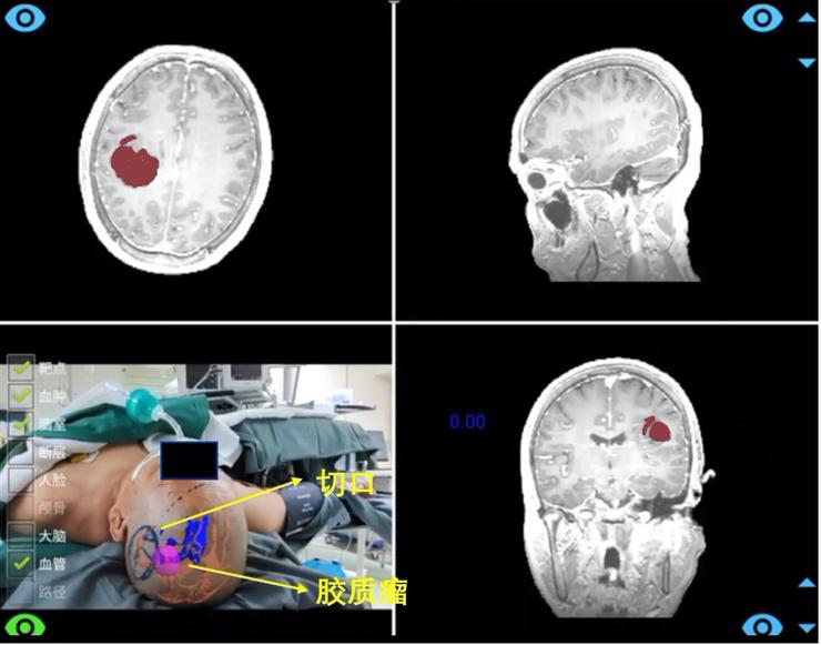协和与腾讯联合发布国产手术导航系统：可一键生成定制化3D“透明脑”，成本降低90%