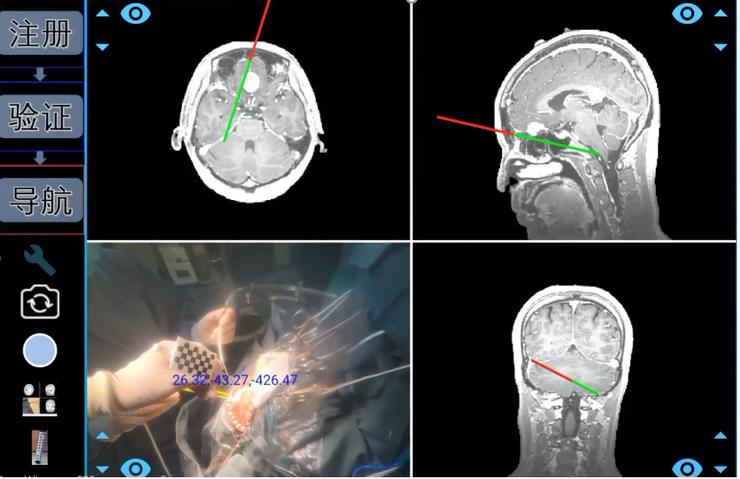 协和与腾讯联合发布国产手术导航系统：可一键生成定制化3D“透明脑”，成本降低90%