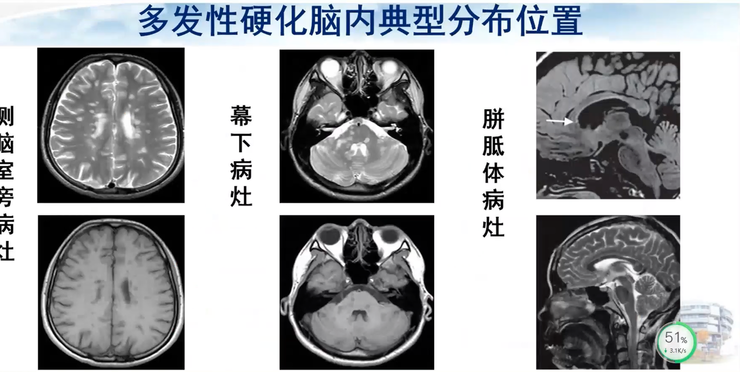 首都医科大学宣武医院副院长卢洁教授：AI在脑脱髓鞘病MRI中，有哪些应用？｜CMAI 2022