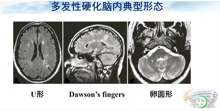 首都医科大学宣武医院副院长卢洁教授：AI在脑脱髓鞘病MRI中，有哪些应用？｜CMAI 2022