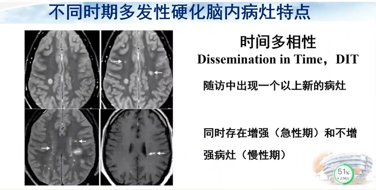 首都医科大学宣武医院副院长卢洁教授：AI在脑脱髓鞘病MRI中，有哪些应用？｜CMAI 2022