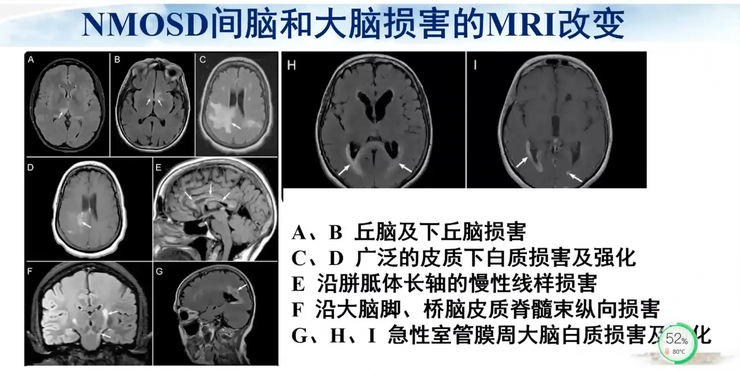 首都医科大学宣武医院副院长卢洁教授：AI在脑脱髓鞘病MRI中，有哪些应用？｜CMAI 2022