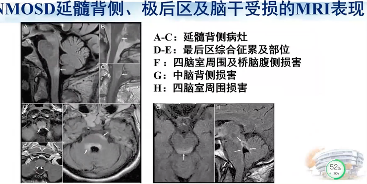 首都医科大学宣武医院副院长卢洁教授：AI在脑脱髓鞘病MRI中，有哪些应用？｜CMAI 2022