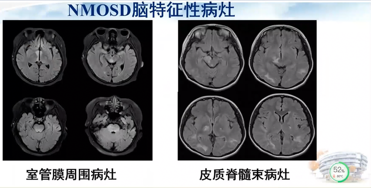 首都医科大学宣武医院副院长卢洁教授：AI在脑脱髓鞘病MRI中，有哪些应用？｜CMAI 2022