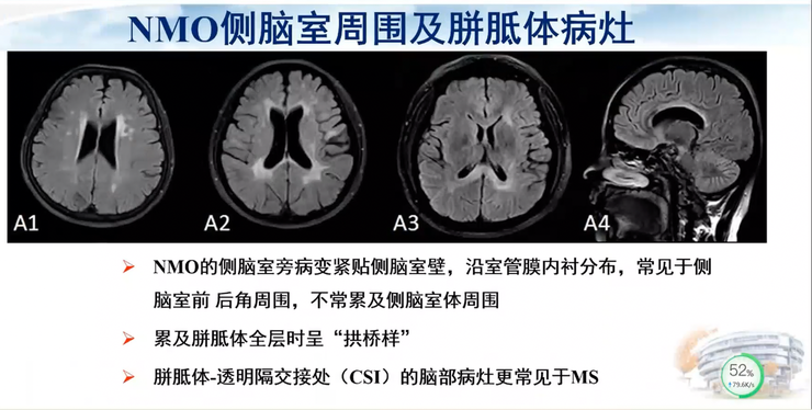 首都医科大学宣武医院副院长卢洁教授：AI在脑脱髓鞘病MRI中，有哪些应用？｜CMAI 2022