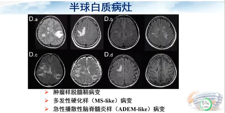 首都医科大学宣武医院副院长卢洁教授：AI在脑脱髓鞘病MRI中，有哪些应用？｜CMAI 2022