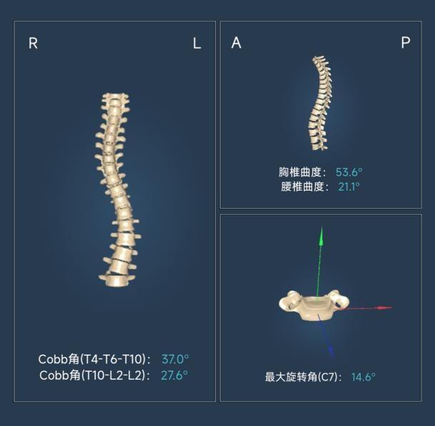 芙索特完成数千万Pre-A轮融资，助力全球儿童青少年脊柱健康筛查与诊疗