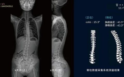 芙索特创始人何丹：以需为引，入局百亿级脊柱测量矫正市场