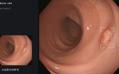 腾讯觅影结肠AI获批上市，助力结肠癌早发现