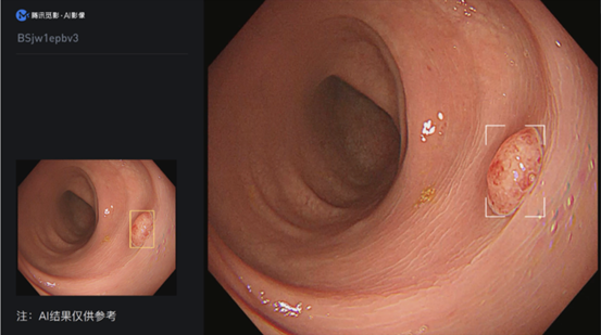 腾讯觅影结肠AI获批上市，助力结肠癌早发现